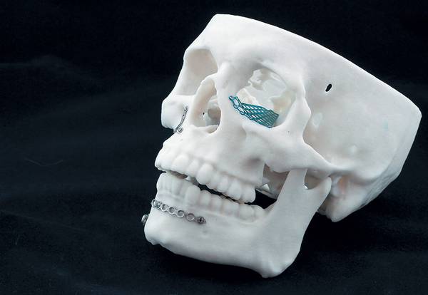3D-модель позволяет хирургу до операции подготовить именно такую пластину, которая будет нужна 018_expert_ural_45-1.jpg